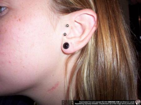 tragus de surface+lobe